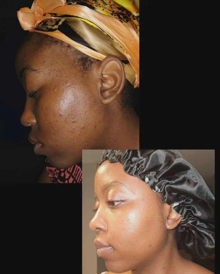 Crème Visage Kojic: Soin Complet Anti-Taches, Acné et Signes de l’Âge