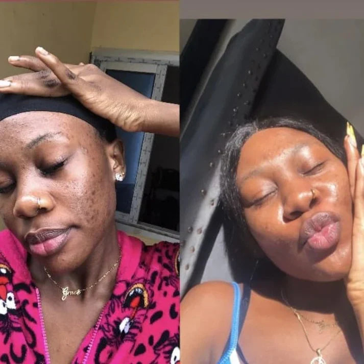 Crème Visage Kojic: Soin Complet Anti-Taches, Acné et Signes de l’Âge