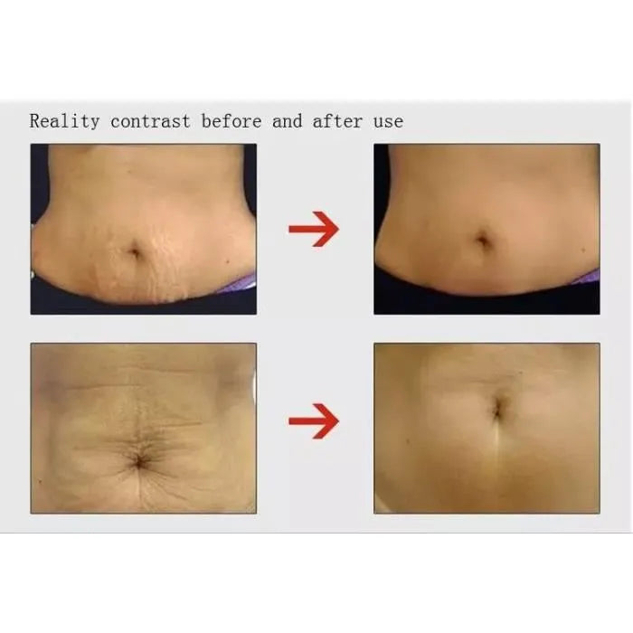 Pastel crème anti vergeture miracle originale thaïlandaise original 50 g